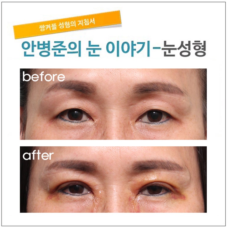 상안검성형술 관련 이미지 2