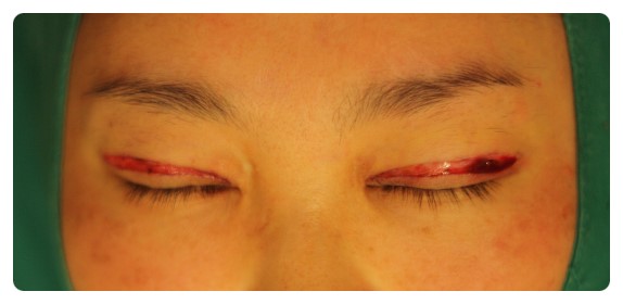 -소시지눈 고치기 과정-        [안병준의 눈이야기] 관련 이미지 4