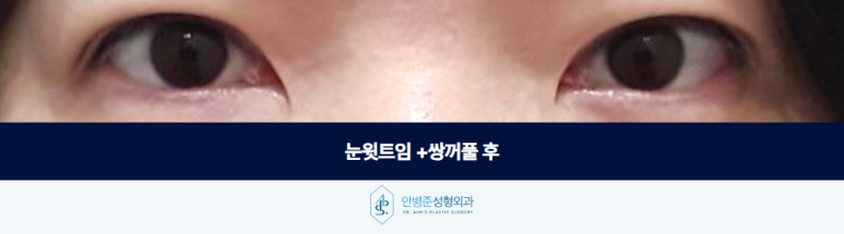 눈윗트임 쌍꺼풀 안검하수라고 섣불리 눈매교정하기보다는 관련 이미지 3