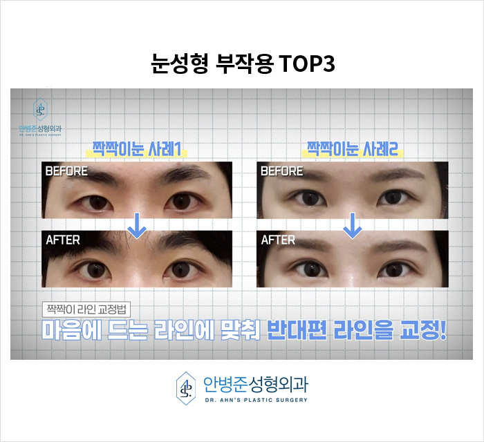 [눈재수술] 짝짝이&middot;풀어짐&middot;불만족, 쌍꺼풀 부작용과 예방 방법은? 관련 이미지 5