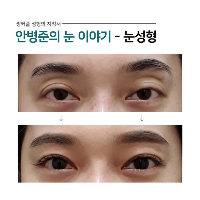 꺼진 눈 수술(지방이식,눈매교정,쌍수) 관련 이미지 1