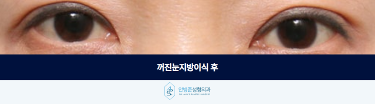 꺼진눈지방이식 볼륨을 채우기 전에 먼저 고려해야 할 점은 관련 이미지 3