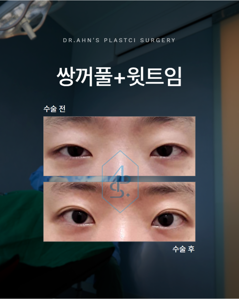 윗트임 가짜안검하수 눈매교정 필요하지 않은 경우 관련 이미지 1