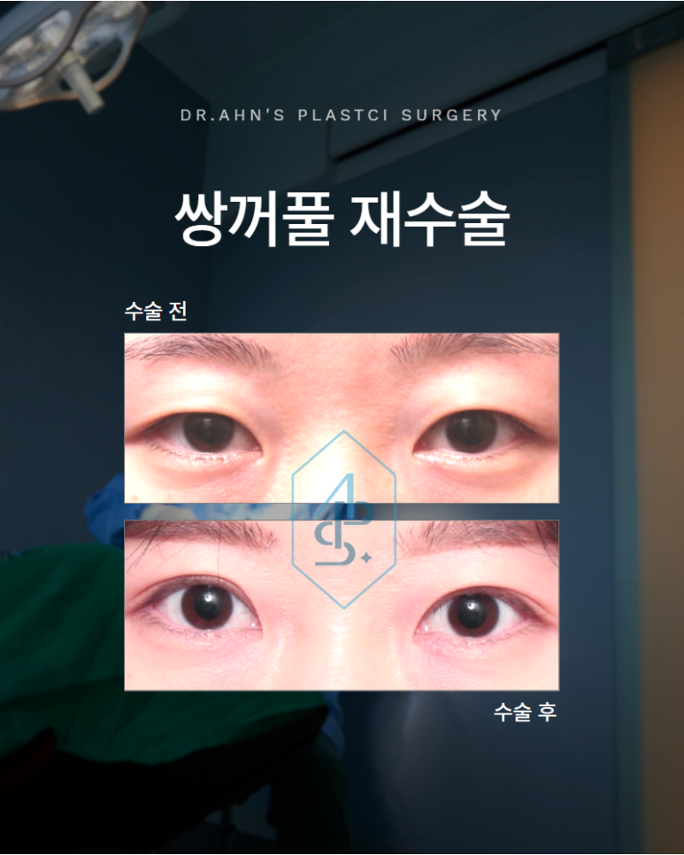 If Your Double Eyelid Line Has Become Hidden Over Time: Revision Surgery image 1