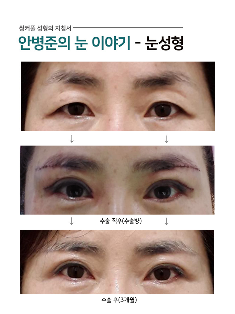 상안검성형술,눈썹밑절제술(노인성 눈꺼풀,중년 눈수술) 관련 이미지 1
