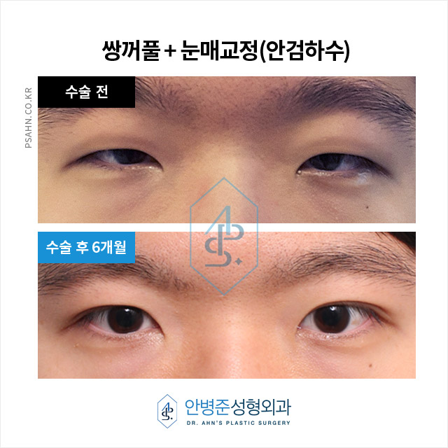 졸린 눈 고민, 이상적인 눈매 디자인과 수술 방법 관련 이미지 1