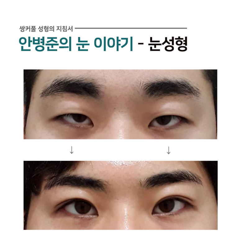 남자눈 일반적 수술방법 #3.(진짜 안검하수,피부절제,윗트임,가짜 안검하수) 관련 이미지 1