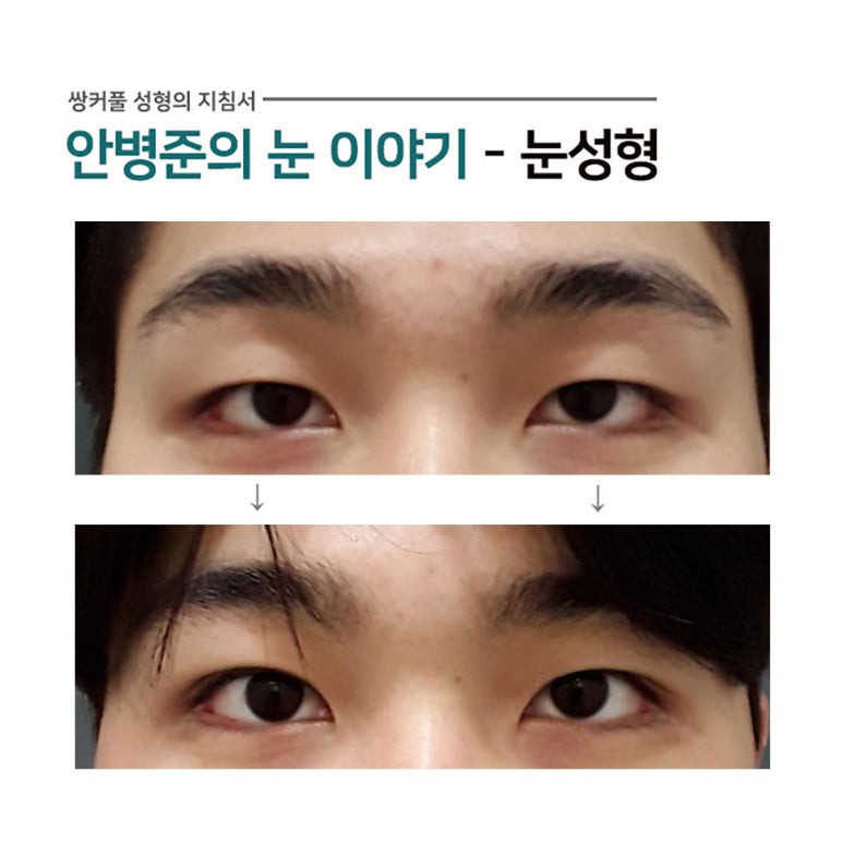 남자 쌍꺼풀 사례(기본눈,처진눈)#1~2 관련 이미지 1