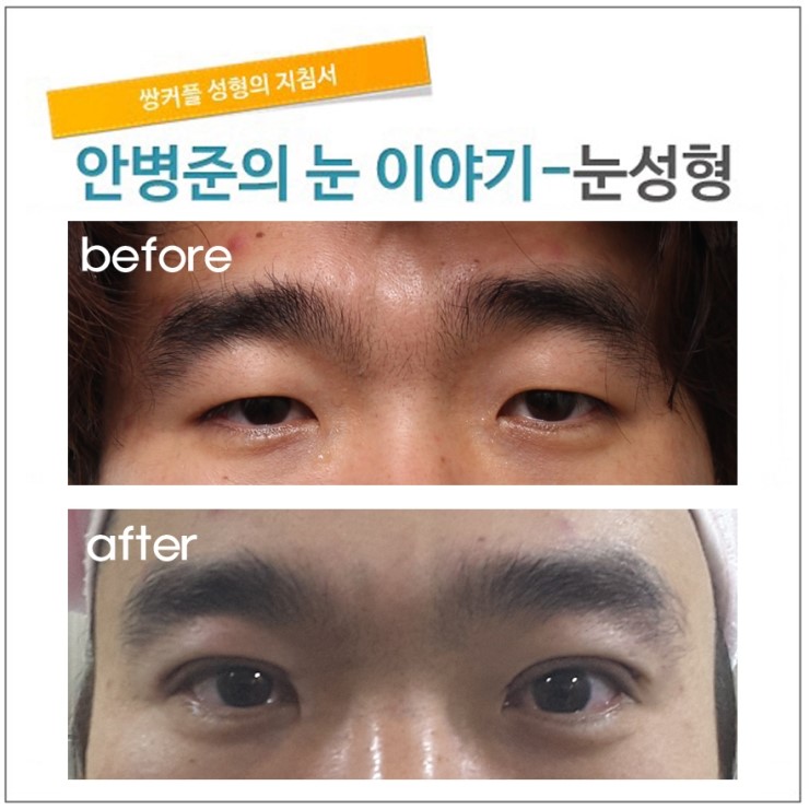 까다로운 남자 쌍꺼풀. 관련 이미지 1