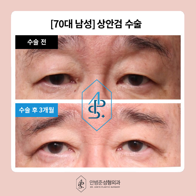 [눈성형]50대도 동안 유지! 상안검&하안검 성형으로 자신감 찾기 관련 이미지 5