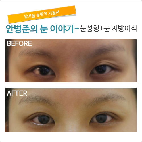 눈성형+눈지방이식 시크릿성형외과_안병준 관련 이미지 1