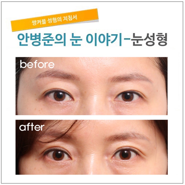 매몰법 후, 피부처짐(매몰법 재수술,절개법) 관련 이미지 1