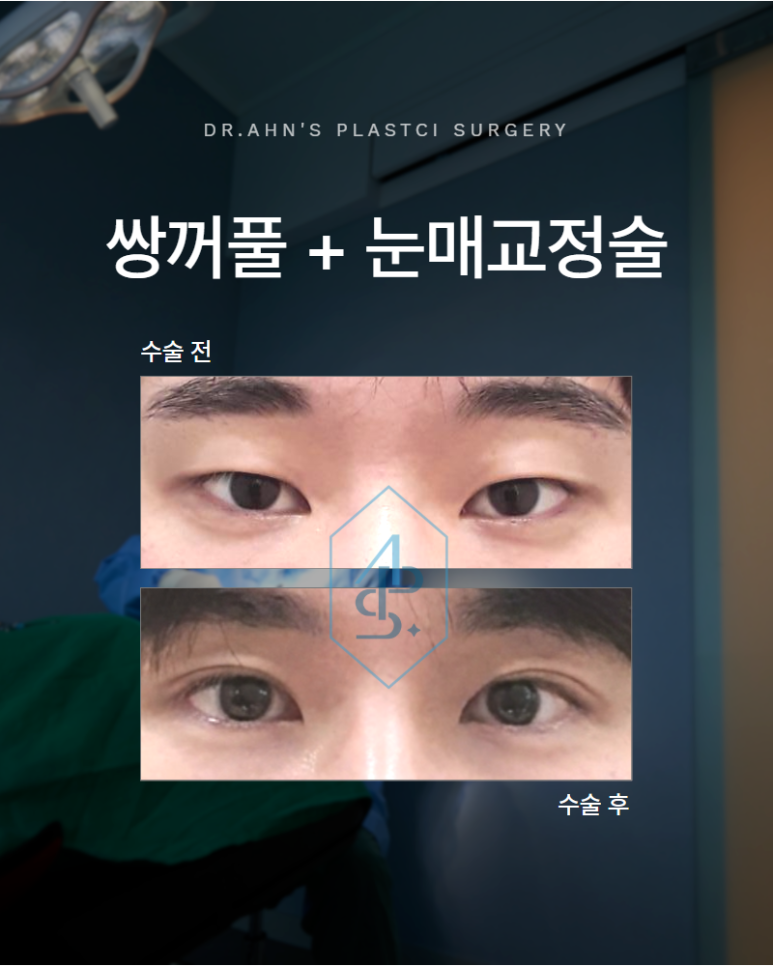쌍꺼풀 수술 눈매교정술 남성 눈에서 더 신경 써야 하는 부분 관련 이미지 1