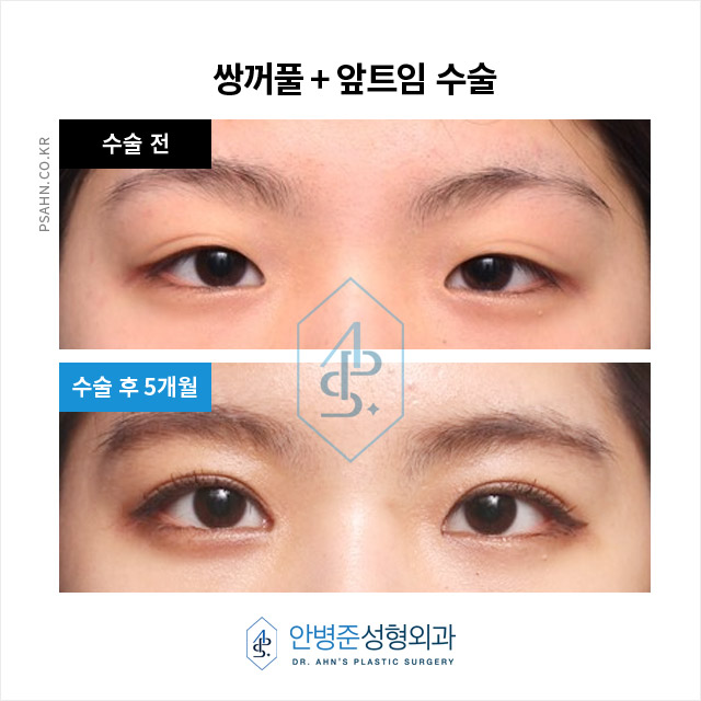 [눈성형] 자연스러운 쌍꺼풀과 윗트임 앞트임 수술 관련 이미지 1