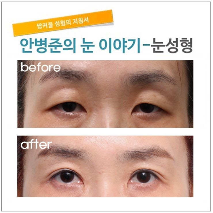중년때 눈에 생기는 복합적인 문제들(안검하수,상안검하수,피부절제,눈매교정) 관련 이미지 1