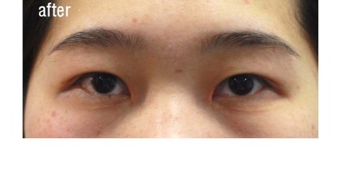 쌍꺼풀&앞트임 2달후.  [안병준의 눈이야기] 관련 이미지 2