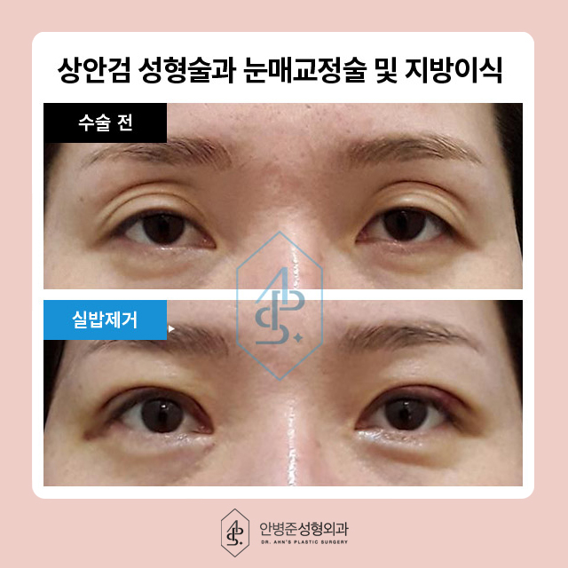 [이벤트] 상안검,하안검,눈썹거상 눈밑 지방재배치 관련 이미지 5