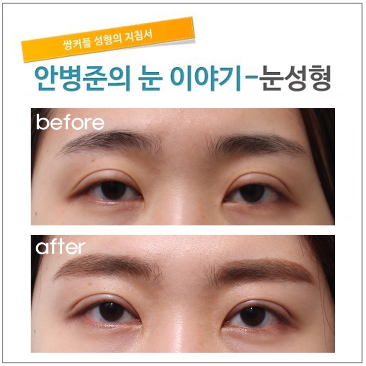 쌍꺼풀 수술후에 눈뜨기가 불편해진 경우. (재수술,라인줄이기,소시지눈,소시지눈재수술) 관련 이미지 1