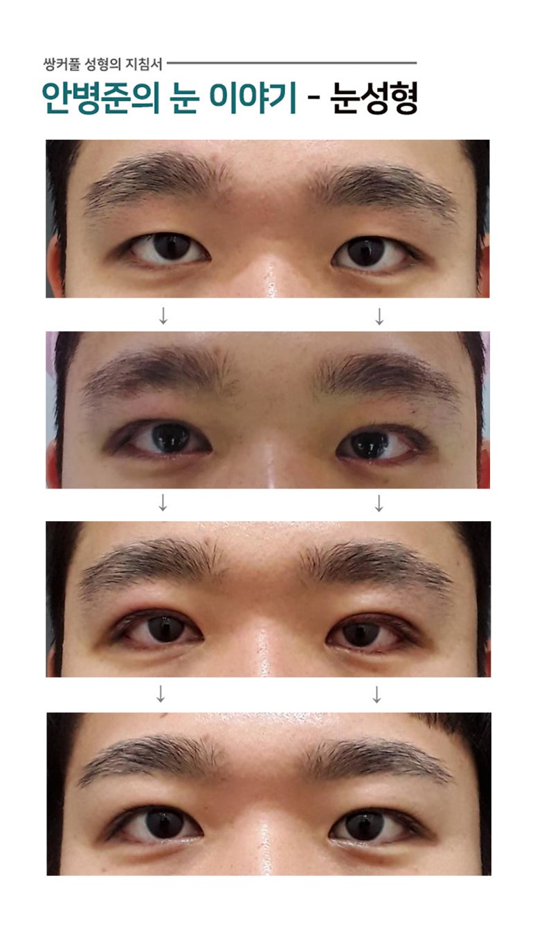 안검하수,짝눈(눈매교정) 관련 이미지 1