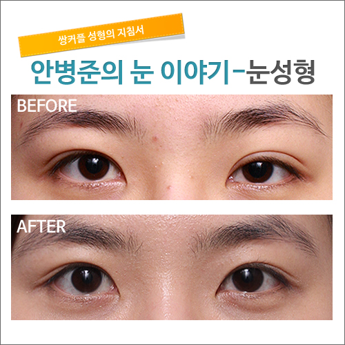 자연스런 쌍꺼풀이란?_시크릿 성형외과 안병준의 쌍꺼풀 지침서 관련 이미지 1