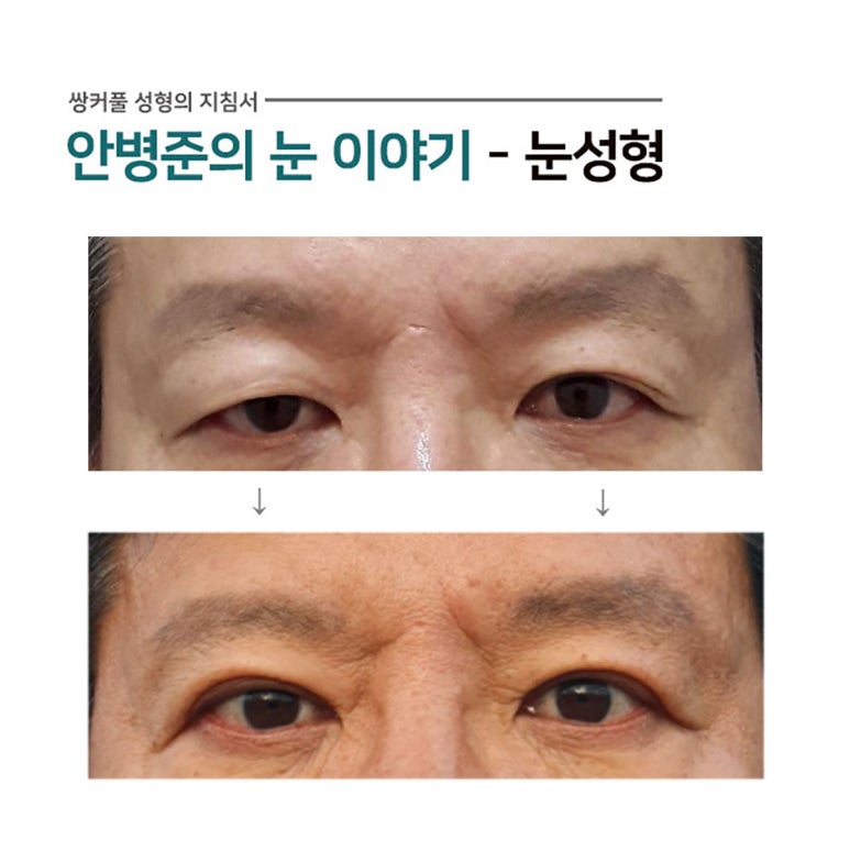 남자 쌍꺼풀 사례(짝눈,노인성눈,상안검성형술)#5~6 관련 이미지 2