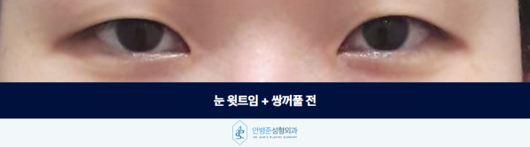 Upper Canthoplasty and Double Eyelid Surgery: If You Do Not Have Ptosis, Ptosis Correction Is Unnecessary image 2