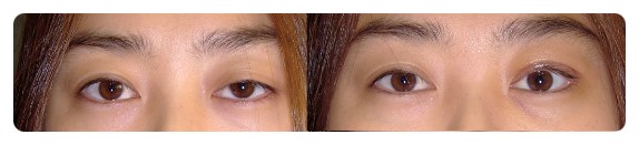 -가짜 안검하수와 진짜 안검하수-        [안병준의 눈이야기] 관련 이미지 5