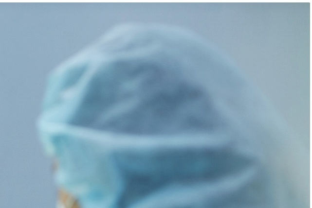 상안검성형술 처진 눈꺼풀로 고민이라면 확인해야 할 것 관련 이미지 11