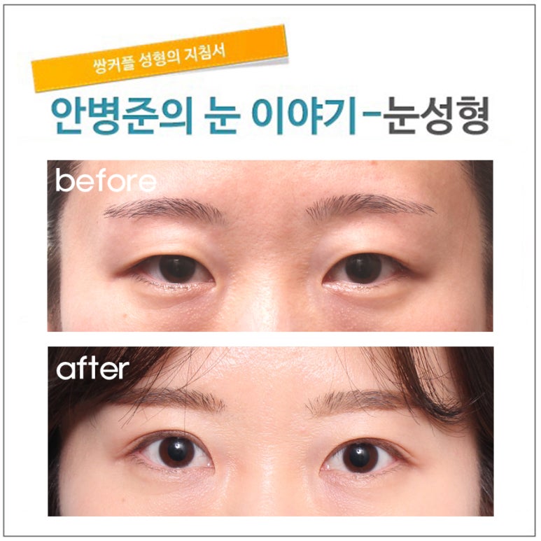 7년전 쌍꺼풀 수술 후, 피부처짐으로 재수술. 관련 이미지 1