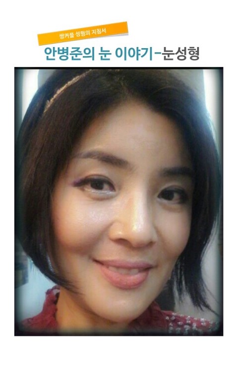 자연스런 쌍꺼풀2_시크릿 성형외과 안병준의 쌍꺼풀 지침서 관련 이미지 4