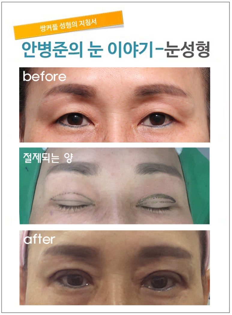 처진 눈꺼풀로 인한 이마주름(상안검) 관련 이미지 1