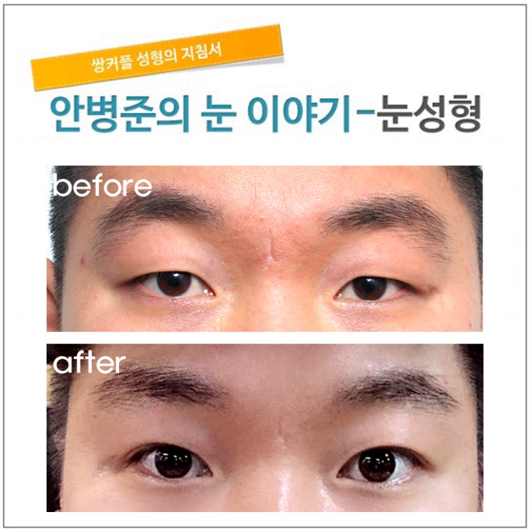 남자 쌍꺼풀에서 라인의 높이(남자 쌍꺼풀) 관련 이미지 1