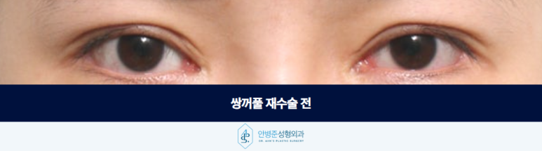 쌍꺼풀 재수술 여러 번 수술한 눈 어디서부터 다시 시작해야 할까요 관련 이미지 2