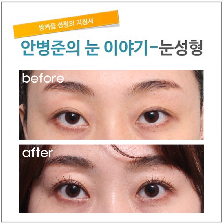 안검하수로 인한 삼백안(재수술) 관련 이미지 1