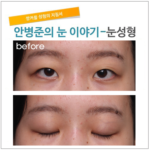 가짜 안검하수.(피부절제,쌍꺼풀수술,절개법) 관련 이미지 1
