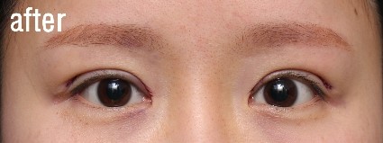 흉터와 라인줄이기 관련 이미지 2