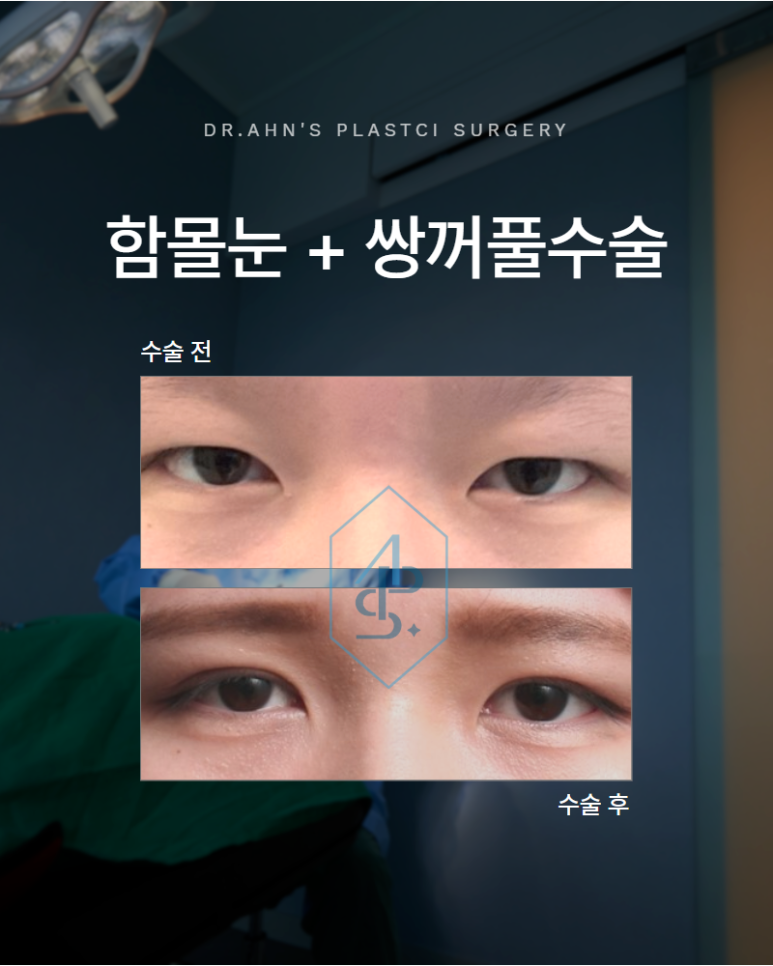 함몰눈 쌍꺼풀수술 꼼꼼한 분석으로 자연스러운 설계 및 개선까지 관련 이미지 1