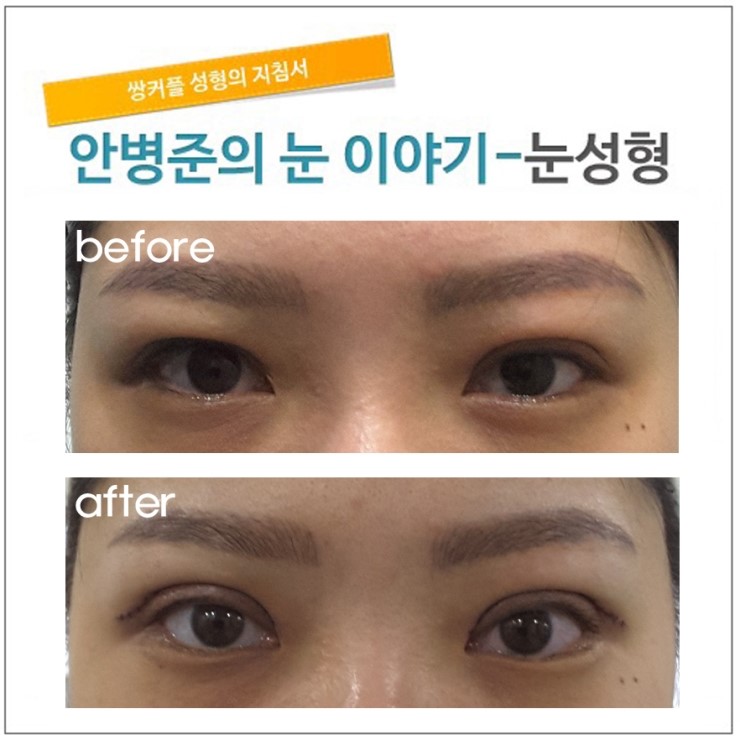 두툼한 쌍꺼풀 재수술. 관련 이미지 1