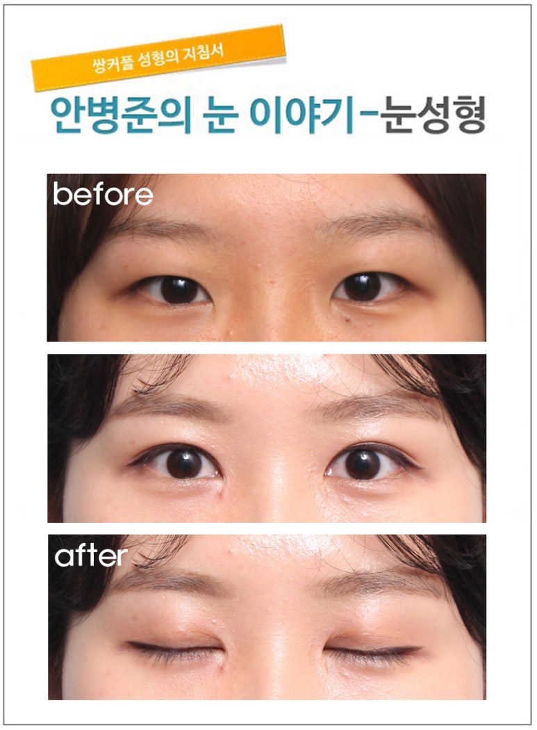 가장 기본적인 절개법(절개법,눈절개법,기본절개법) 관련 이미지 1