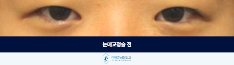 Ptosis Correction Surgery: If Your Eyebrows Are Raised, Improve Ptosis First image 2