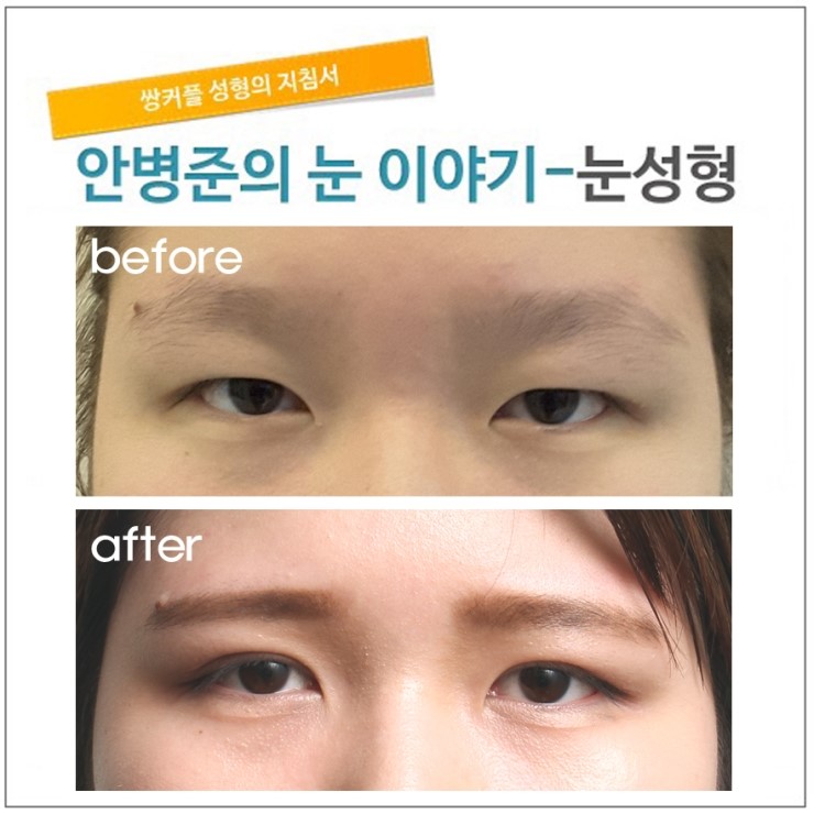 함몰눈 쌍꺼풀수술로 해결하기. 관련 이미지 1