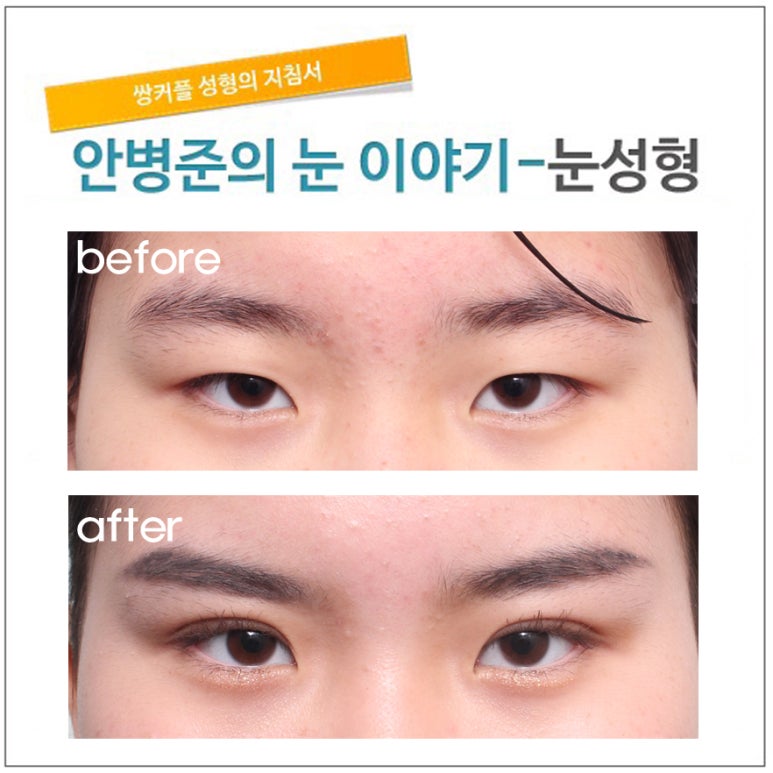 같은 듯, 다른 듯 자매의 눈(절제술,눈매교정,안검하수,피부절제,삼백안,삼백안교정) 관련 이미지 1