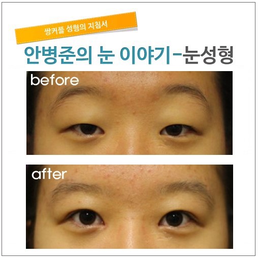 눈매교정 3달 후. 관련 이미지 1