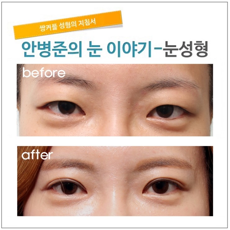 완전히 풀어진 쌍꺼풀 관련 이미지 1