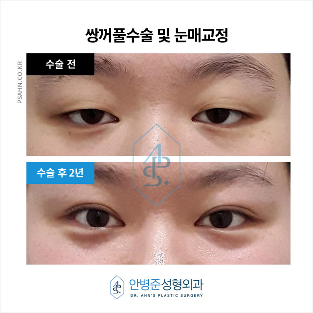 [방배역성형외과] 쌍꺼풀수과 눈매교정술 수술사례 관련 이미지 2