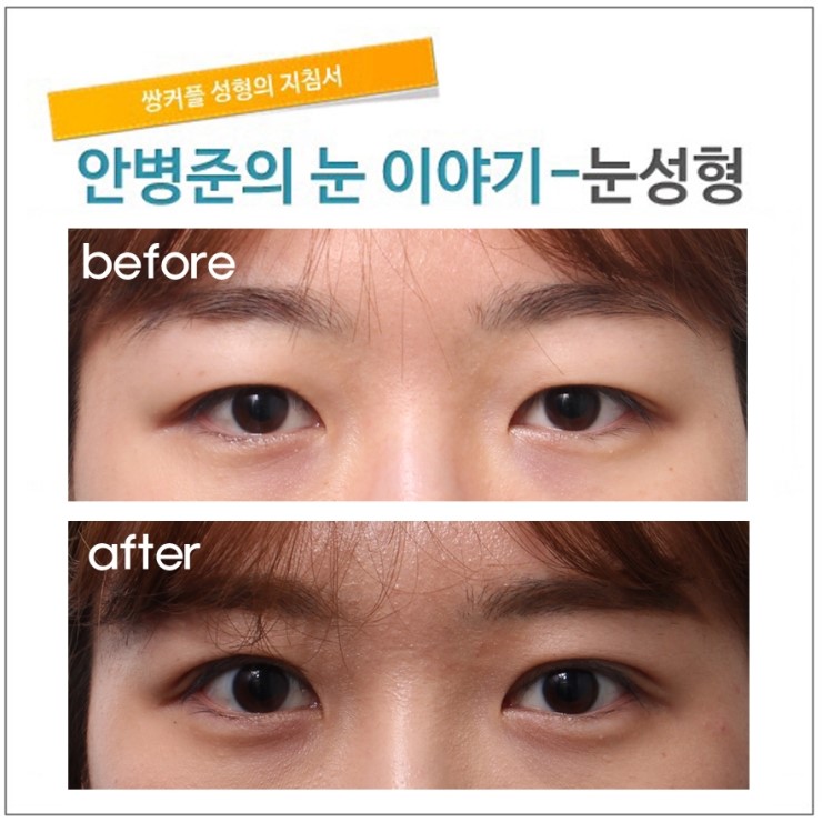 가벼운 쌍꺼풀(쌀꺼풀수술,자연스러운쌍꺼풀수술) 관련 이미지 1