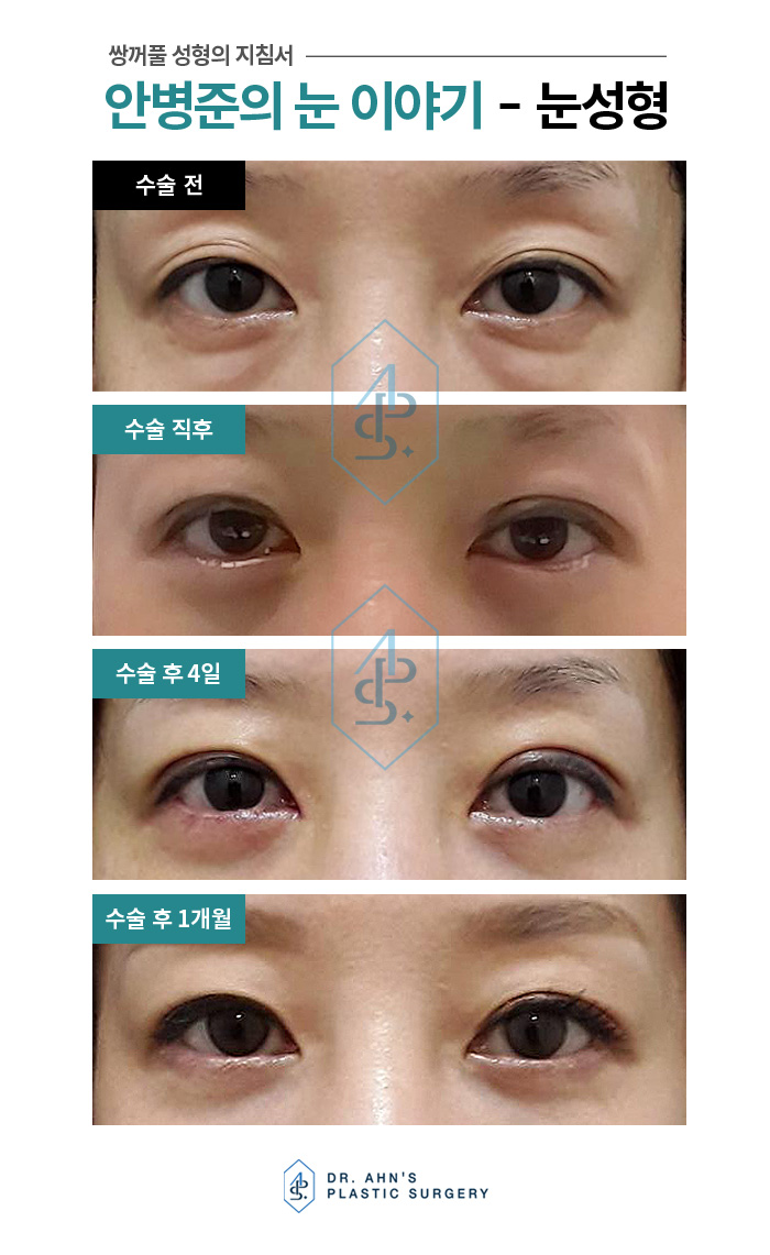 [강남역성형외과] 상안검,하안검 수술의 숨겨진 비밀 관련 이미지 2