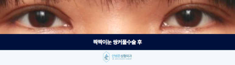 쌍커풀수술 짝짝이눈 고민될때 짚어봐야 할 점은 관련 이미지 3