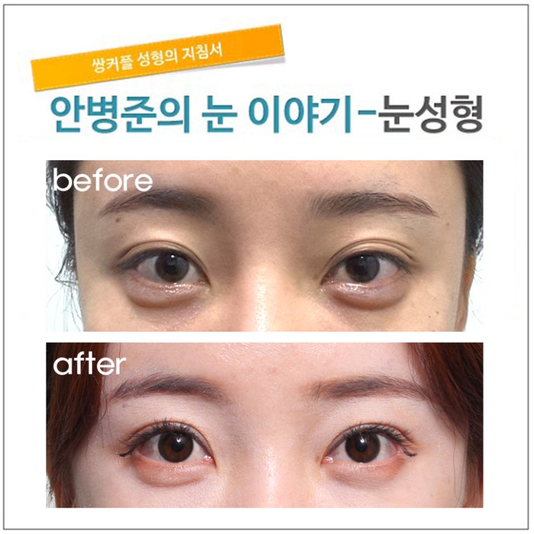 크고 화려한 스타일을 선호하는 중국인(재수술) 관련 이미지 1