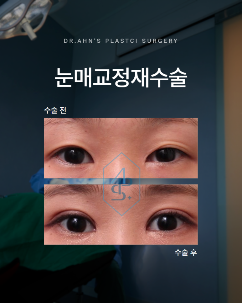 눈매교정재수술 라인이 풀리고 졸려 보인다면 확인해야 할 것은 관련 이미지 1